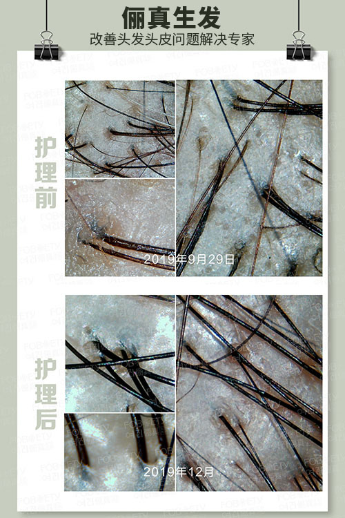 頭油、頭癢