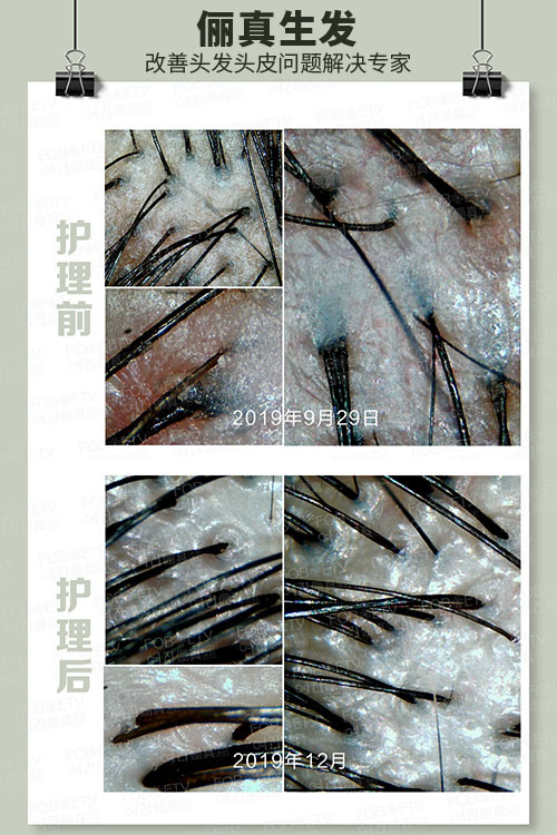 頭油、頭癢
