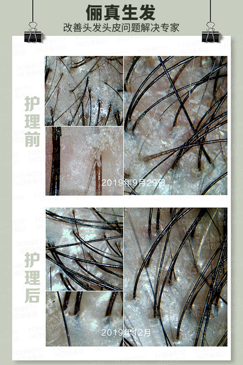 頭油、頭癢